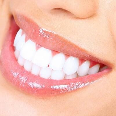 How Much Does Laser Teeth Whitening Cost In Jeddah?