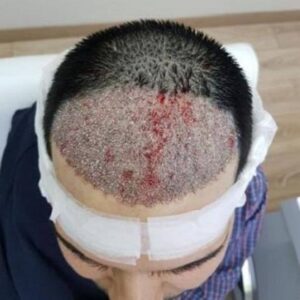 How has hair transplantation improved through evolution?