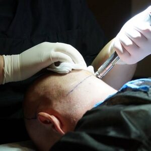 How long does Hair Transplant take?