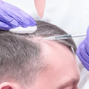 Is PRP Hair Treatment A Permanent Solution For Hair Loss?