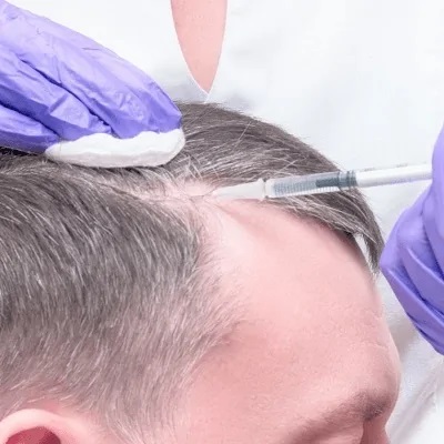 Is PRP Hair Treatment A Permanent Solution For Hair Loss?
